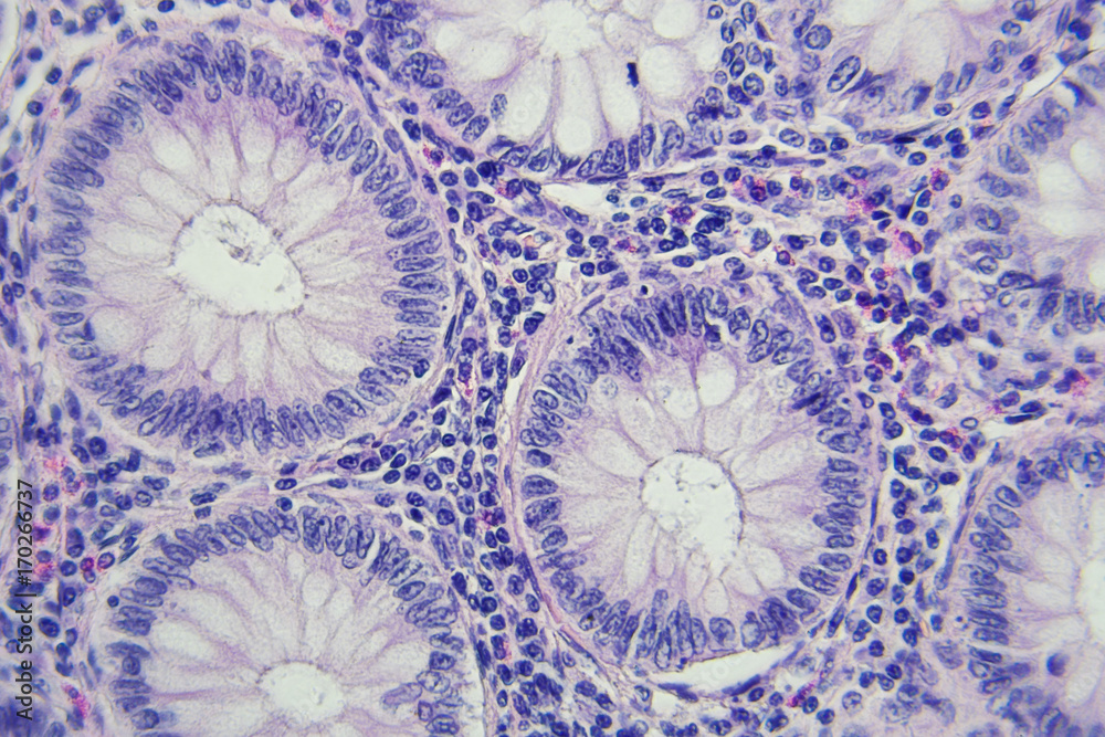 Onco-hematological Diseases